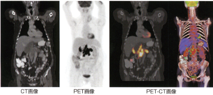 PET-CT検査とは？